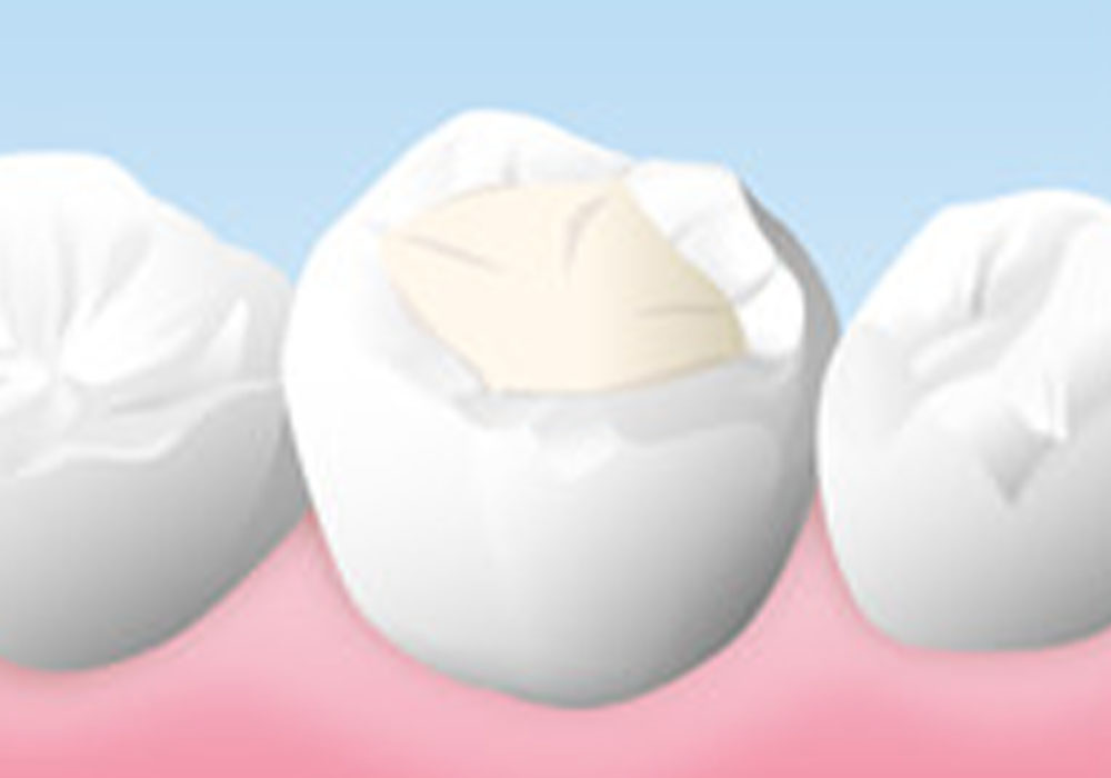 歯科用プラスチックの詰め物
                    （コンポジットレジン）
                    