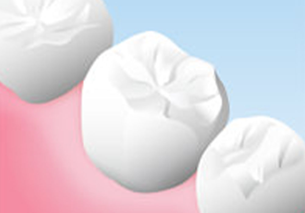 セラミックの詰め物・被せ物