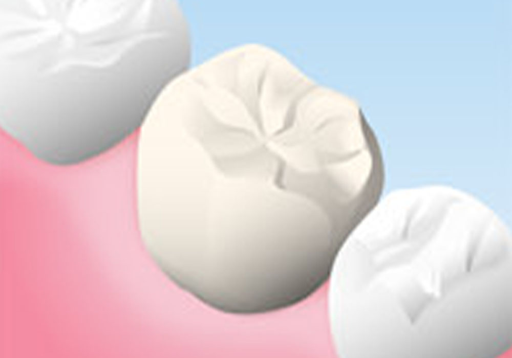 ハイブリッドの詰め物・
                    被せ物
                    