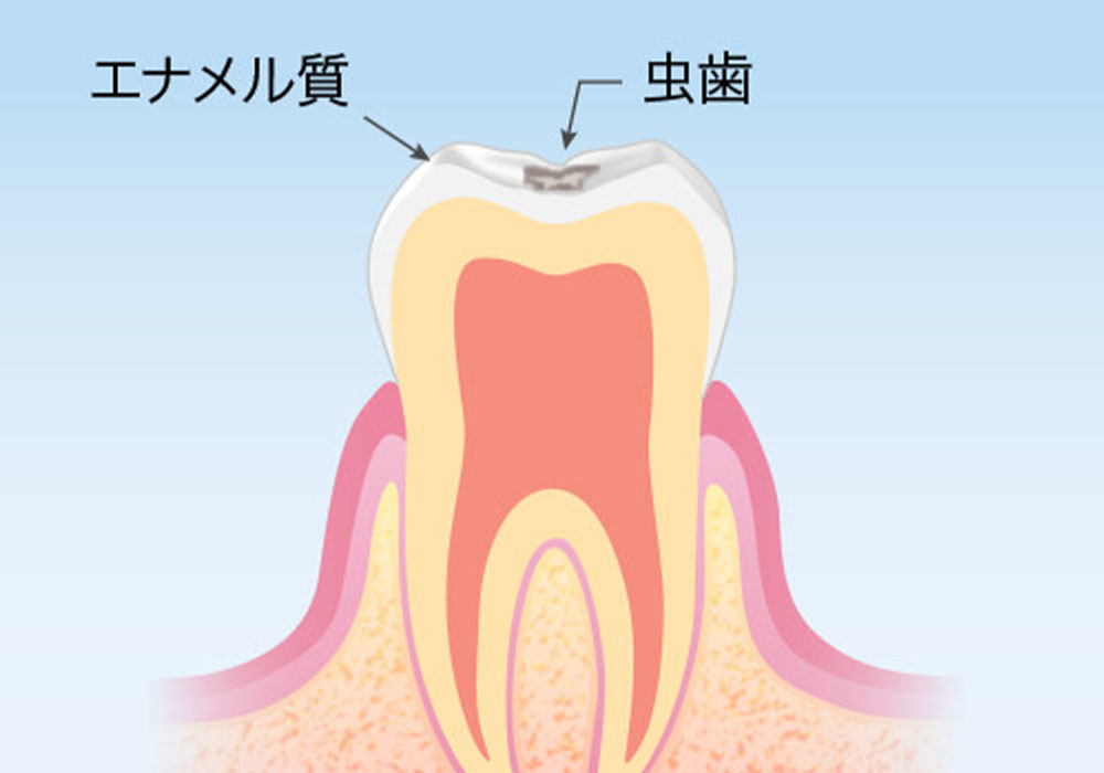 むし歯の原因は？