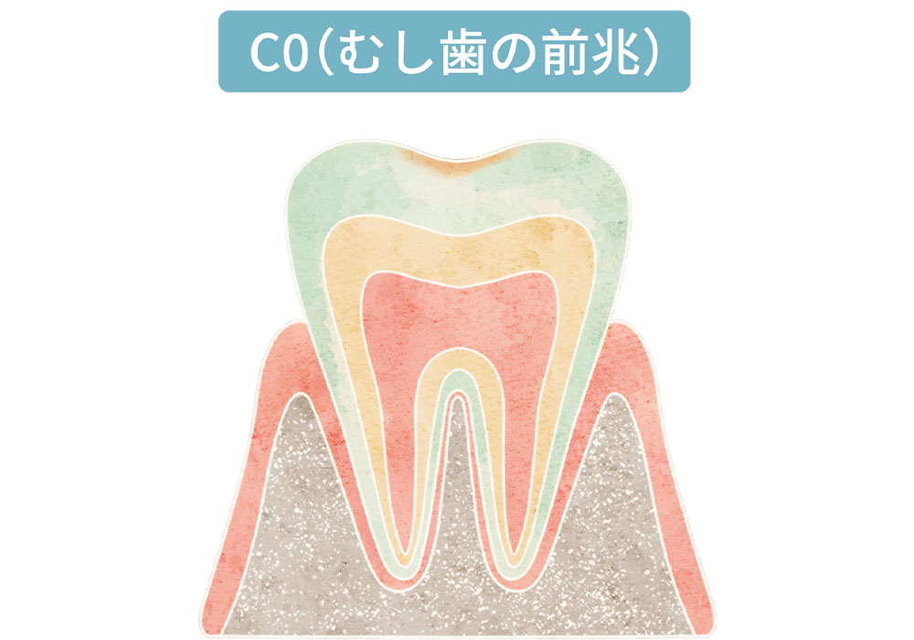初期むし歯（CO）