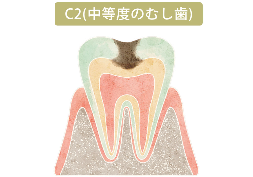 象牙質まで進行したむし歯（C2）