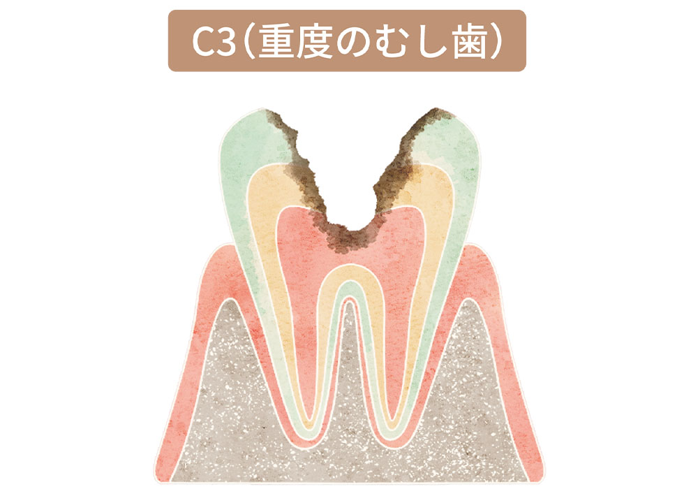 神経まで進行したむし歯（C3）