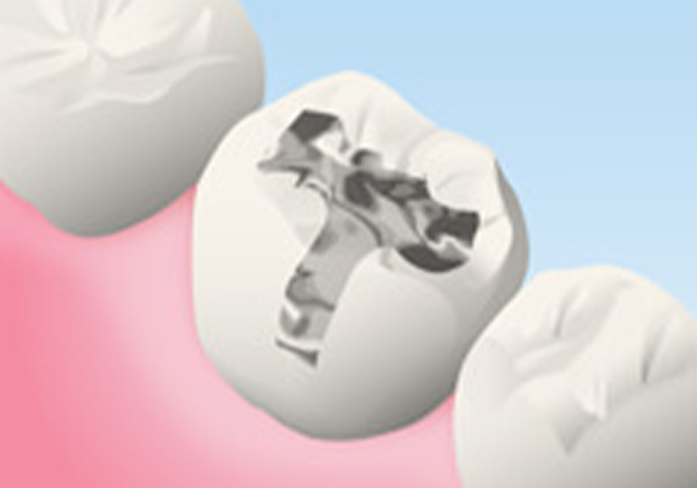 金属の詰め物・被せ物