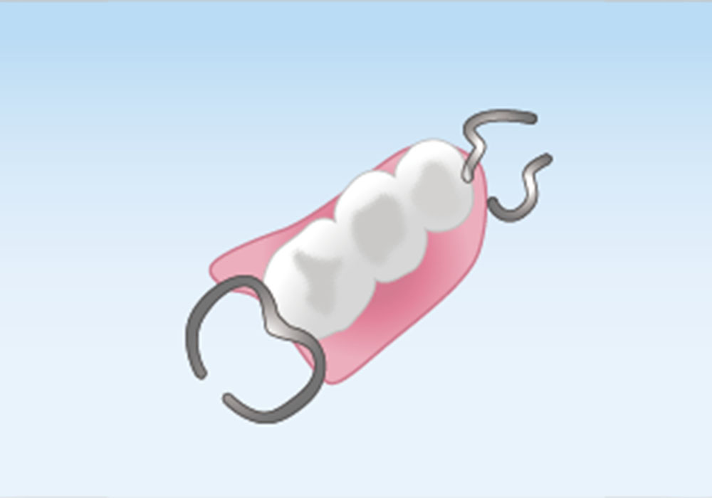金属のバネを使った義歯（保険診療の部分入れ歯）