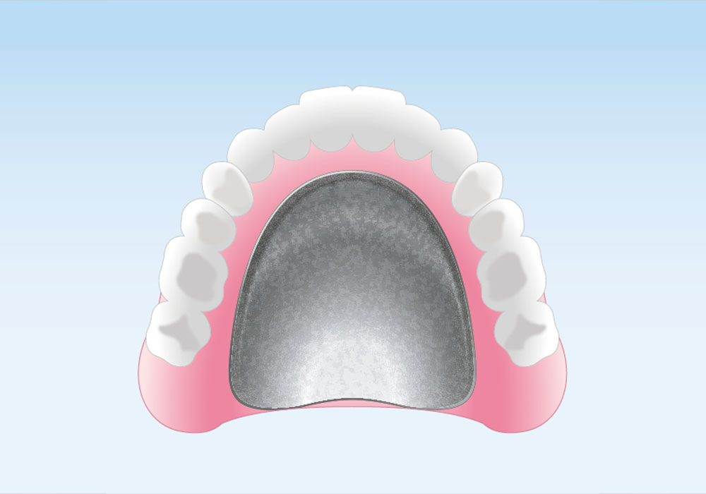 金属床義歯（自由診療の総入れ歯）