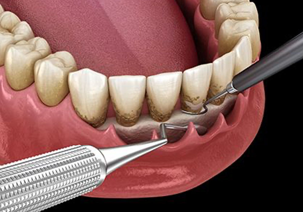 進行した歯周病の治療