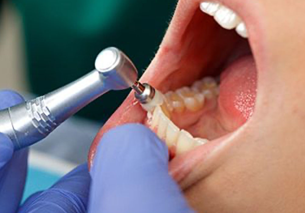 予防歯科の内容