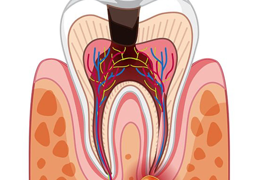 どのような場合に根管治療になるの？