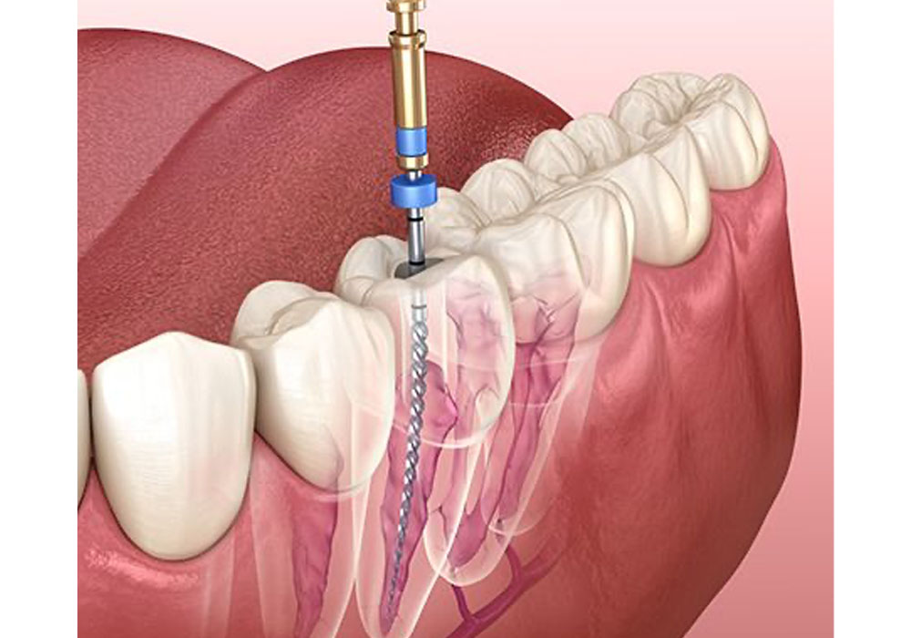 根管治療では何をするの？