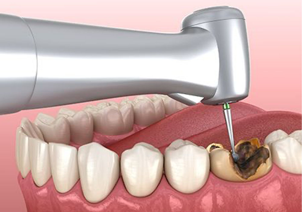 歯髄まで歯を削る
