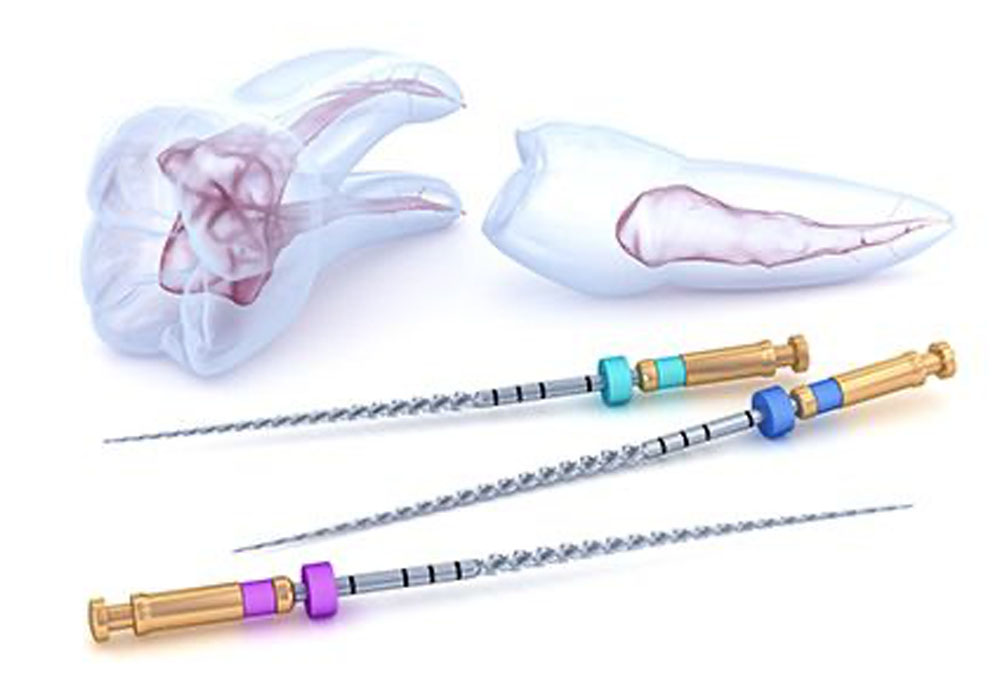 感染した歯髄の除去